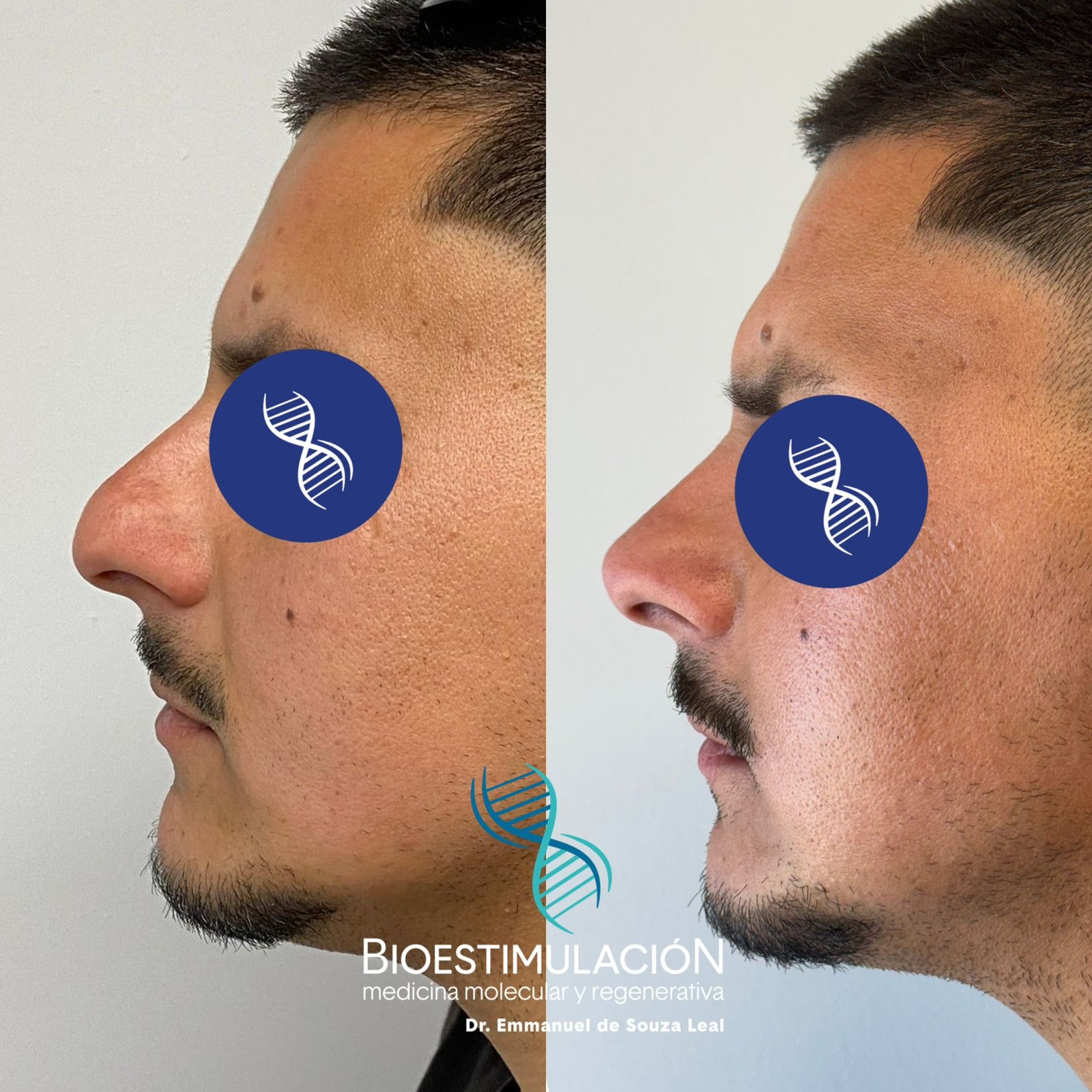 Resultado de tratamiento capilar - Bioestimulación